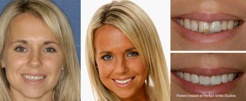 Whitening Dental Crowns at Home: Safe Methods and Effective Techniques